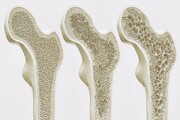 نانوذرات سلنیوم باعث درمان پوکی استخوان در دوره یائسگی می‌شود