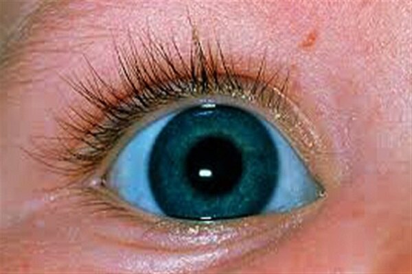 آبی شدن سفیدی چشم کودکان نشانه چیست؟