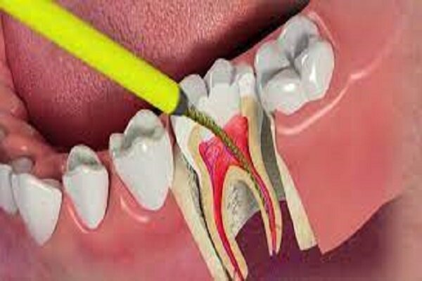 تفاوت درمان ریشه دندان با عصب کشی در چیست؟