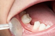 عوامل مؤثر در از دست رفتن دندان‌ها