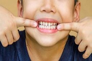 اولین نشانه‌های پوسیدگی دندان کودکان چیست؟