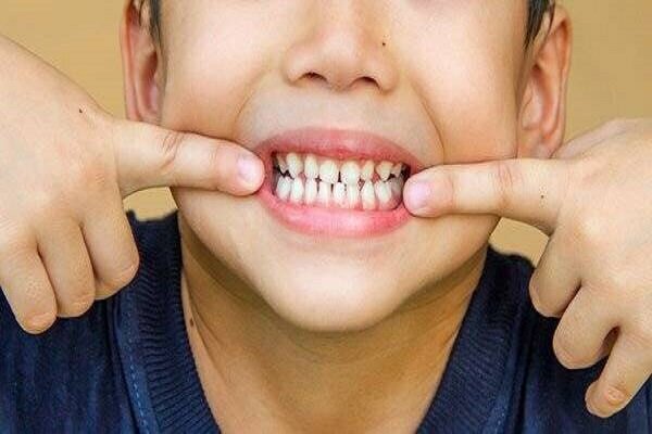 اولین نشانه‌های پوسیدگی دندان کودکان چیست؟