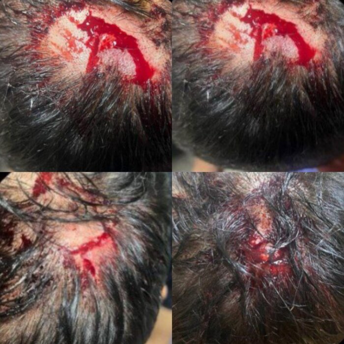 مصدومیت خونین نعمتی در بازی با ذوبآهن/ خطر رفع شد + عکس