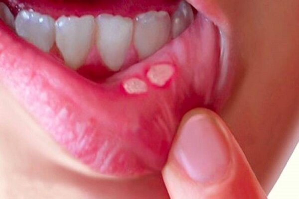 روش‌های طب سنتی برای درمان آفت دهان