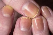 کدام بیماری‌ها از طریق ناخن‌ها خود را نشان می‌دهند