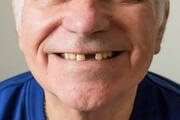 آزمایش داروی رشد مجدد دندان بر روی انسان