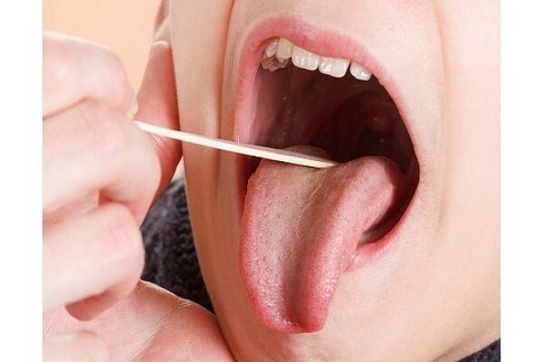 دلیل سوزش زبان چیست؟ دلیل سوزش زبان چیست؟