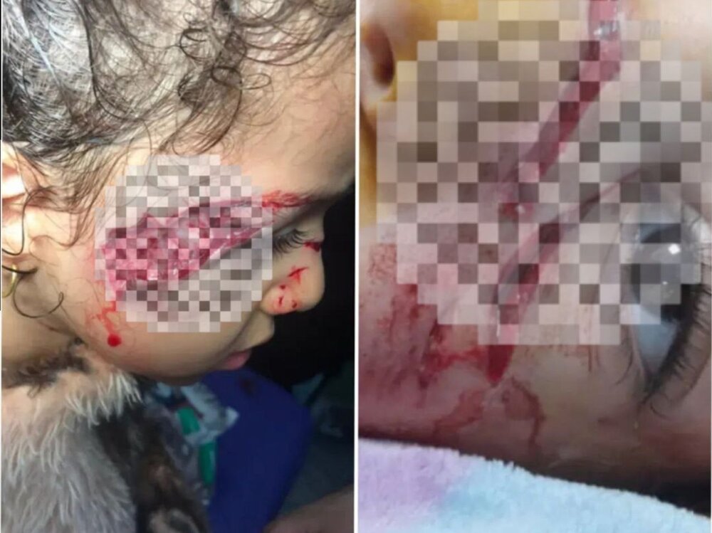 زخمی شدن دختر ۵ ساله تبریزی بر اثر حمله سگ‌های ولگرد ‌+ عکس