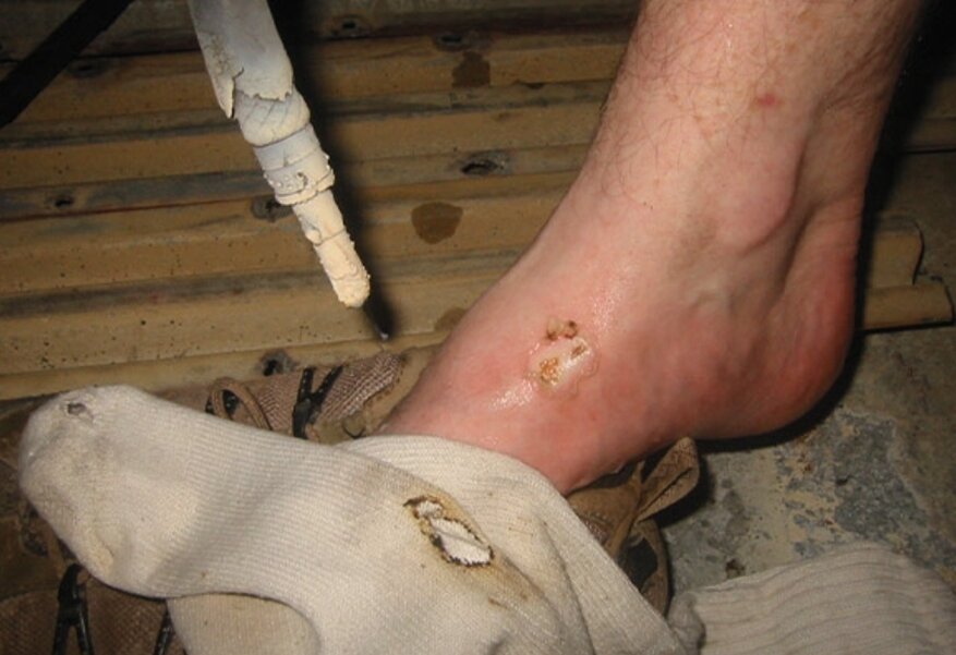 سوختگی با جوشکاری: درمان + روش های پیشگیری