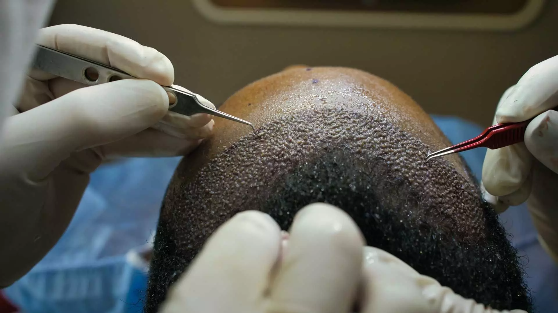 هزینه کاشت مو در اصفهان و مشهد: بررسی جامع هزینهها و روشها