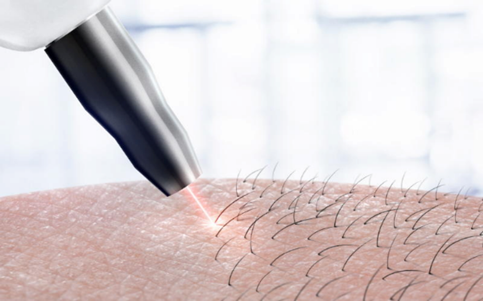 بهترین مرکز لیزر مو در تهران