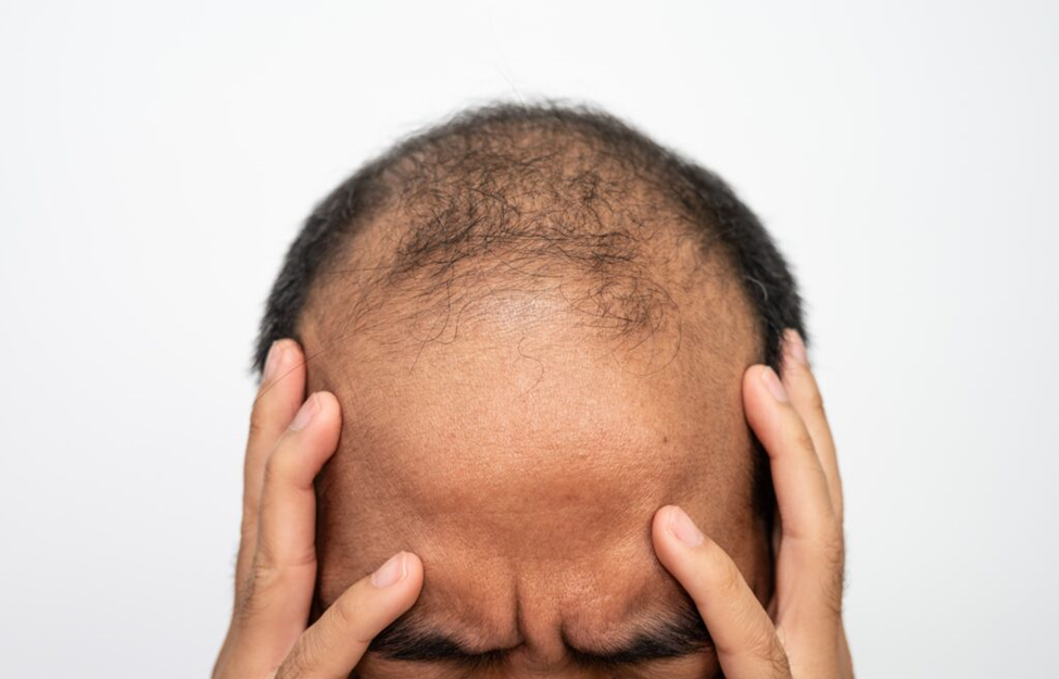 کاشت هر تار مو چقدر هزینه دارد؟ مقایسه دقیق هزینهها