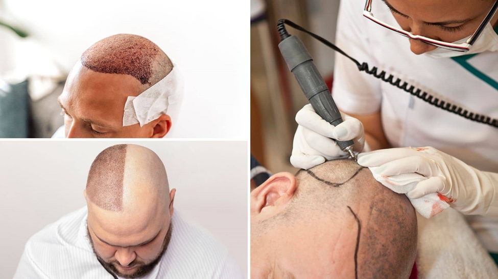 کاشت هر تار مو چقدر هزینه دارد؟ مقایسه دقیق هزینهها