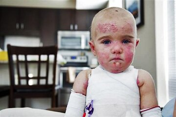 مدارس بیماران ای‌بی را قبول نمی‌کنند/ تحریم و مکانیسم ماشه چه مشکلاتی برای بیماران پروانه‌ای به وجود آورده است؟