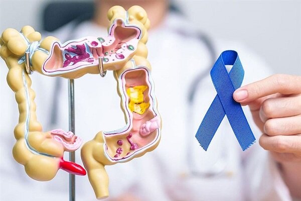 ۴ علامت اولیه سرطان روده بزرگ در جوانان ۴ علامت اولیه سرطان روده بزرگ در جوانان
