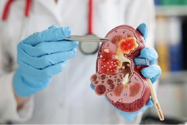خطرات کمآبی بدن برای کلیهها خطرات کمآبی بدن برای کلیهها