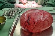خروج توده ۴ کیلوگرمی از شکم یک بیمار در آمل