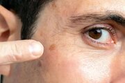 نشانه‌های اولیه سرطان پوست