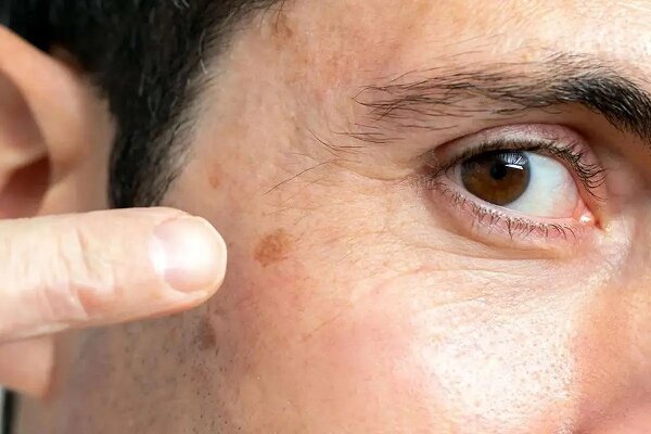 نشانه‌های اولیه سرطان پوست