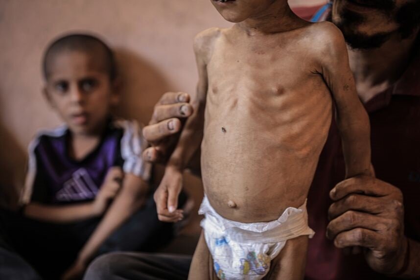 یونیسف: ۹۳۰۰ کودک در نوار غزه دچار سوءتغذیه حاد هستند
