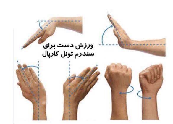 سندروم تونل کارپال چیست؟