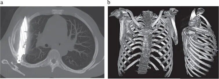 عجیب اما واقعی؛ چاقویبزرگی که ۱۰سال در سینه یک مرد فرو رفته بود و نمی‌دانست + عکس