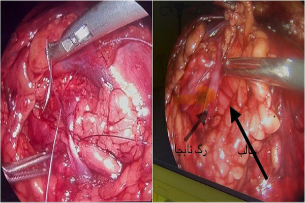 جراحی تنگی مادرزادی حالب برای اولین بار در اردبیل