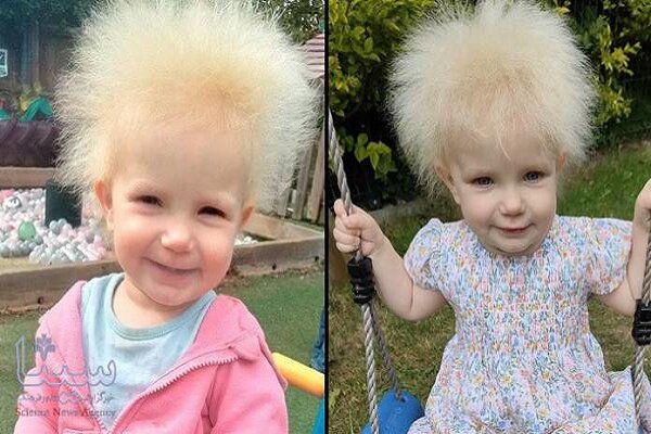 سندروم موی اینشتین چیست؟