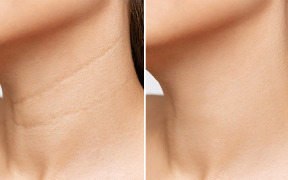 چطور فیلر و مزوژل گردن شما را چند سال جوان تر میکنند، بدون جراحی!