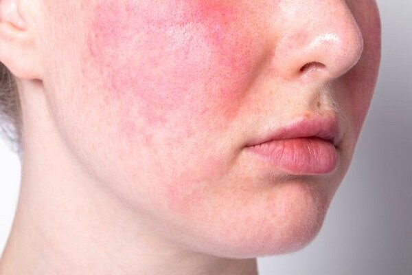 سرنخی جدید در درمان بیماری‌ لوپوس