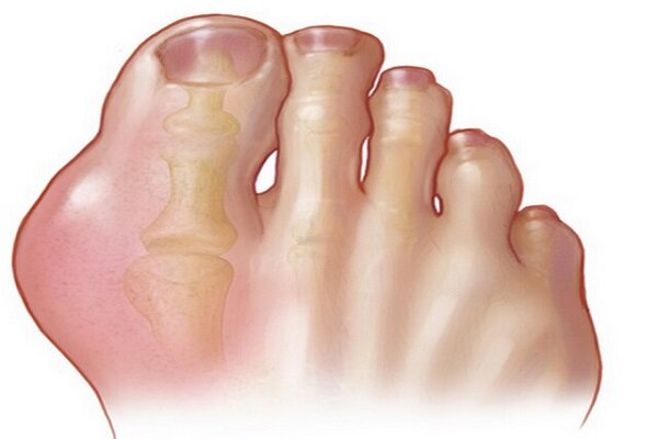 نقرس چیست و درمان اصولی آن چگونه است؟