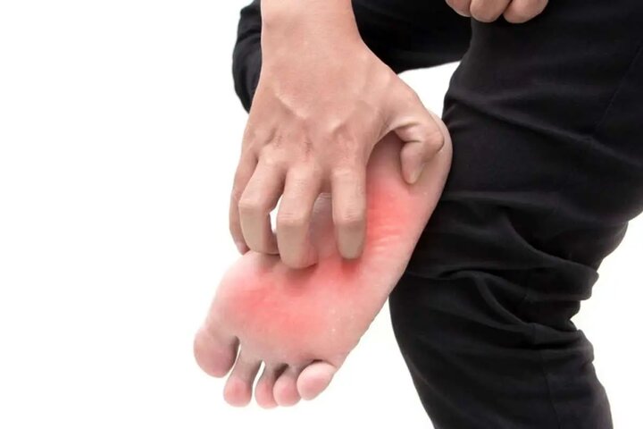خارش کف پا نشانه کدام بیماری است؟ خارش کف پا نشانه کدام بیماری است؟