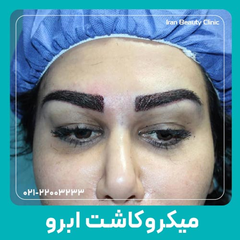 آشنایی با میکرو کاشت ابرو به عنوان بهترین روش کاشت ابرو در ایران