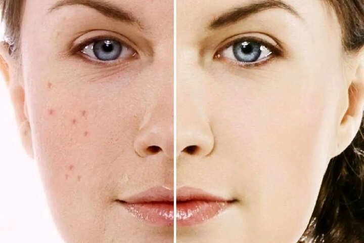 ماسکهای خانگی برای رفع جوشهای صورت ماسکهای خانگی برای رفع جوشهای صورت