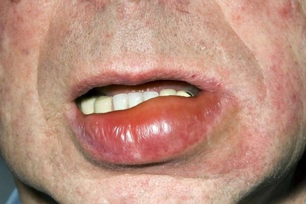 چرا بعضی افراد صبح با لب های متورم بیدار می شوند؟
