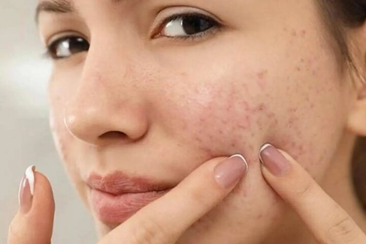 جوش صورت نشانه بالا بودن تستوسترون است؟