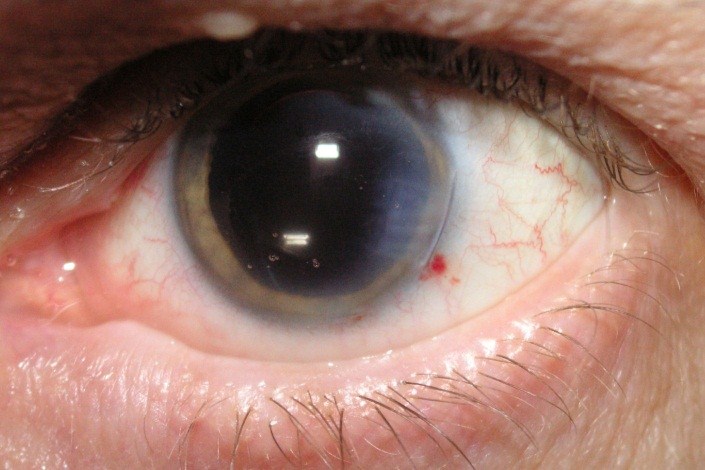 عدسی چشم انسان می‌تواند بعد از عمل آب مروارید دوباره رشد کند