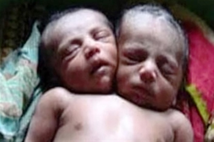 ویدیو / تولد نوزاد دو سر در بنگلادش 