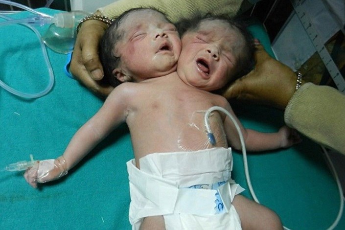 تولد نوزاد دو سر در بنگلادش + عکس/چون اعضای اصلی بدن یکی هستند امکان جدا کردن وجود ندارد