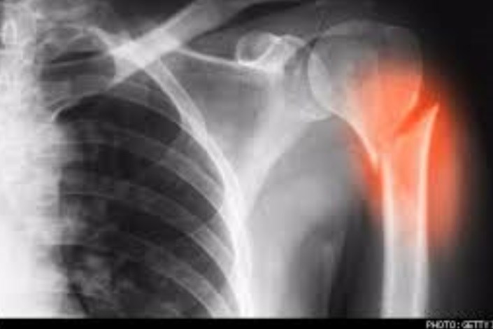 موفقیت محققان ایرانی درترمیم استخوان های آسیب دیده به کمک فناوری نانو