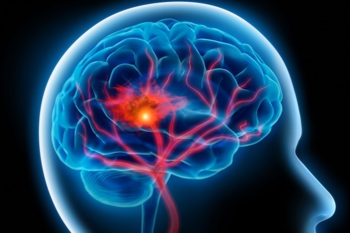 بازتوانی بیماران سکته مغزی با استفاده از تکنولوژی واقعیت مجازی