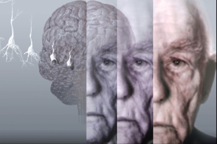 چگونه از بیماری آلزایمر مصون بمانیم؟