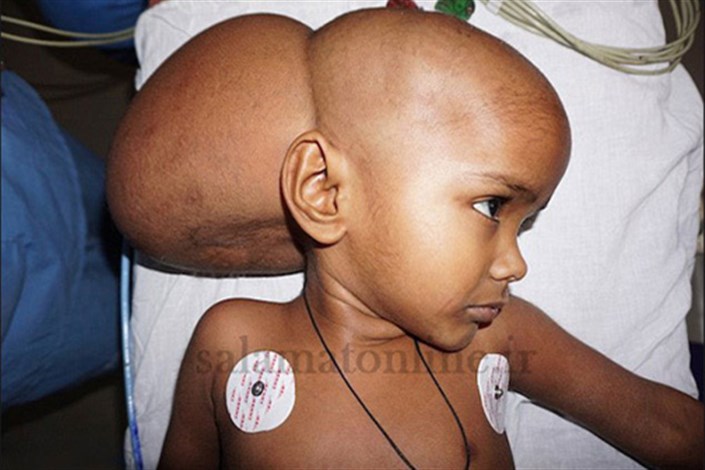 تومور 3 کیلویی در سر دختر 4 ساله هندی +عکس