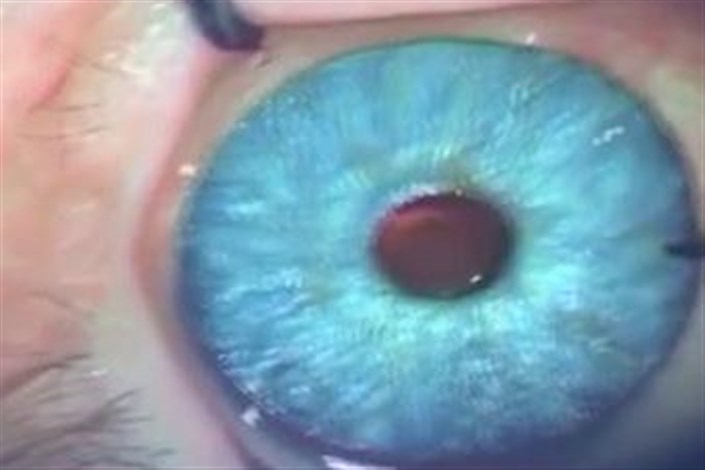 ویدیو /  جراحی زیبائی، این بار تغییر دائمی رنگ چشم!