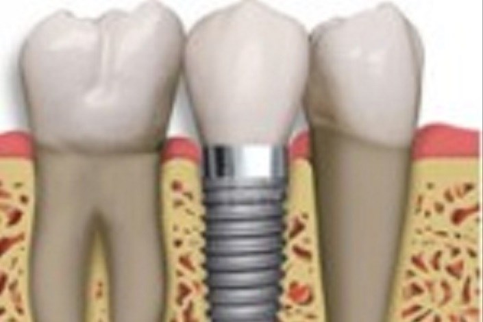 افزایش طول عمر ایمپلنت های دندانی و استخوانی با استفاده از نانوکامپوزیت ها