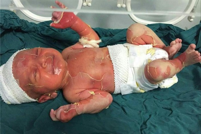 مقصر سوختگی  نوزاد سه روزه  در بیمارستان صومعه سرا  کادر درمانی بیمارستان نیست/ تایید ابتلای کودک به یک بیماری عفونی
