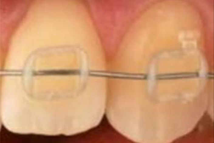 محافظت از دندان‌ها با استفاده از نانوذرات