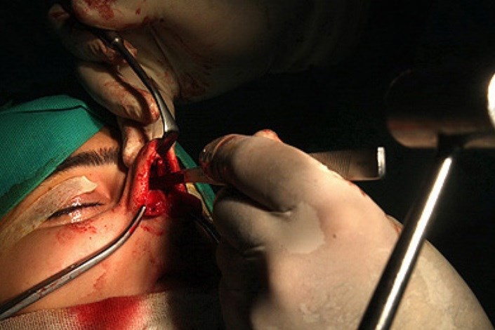 ایران رتبه اول جراحی های زیبایی  در دنیا را دارد/تب جراحی بینی  افتاد ؛ چشم گربه ای مد شد