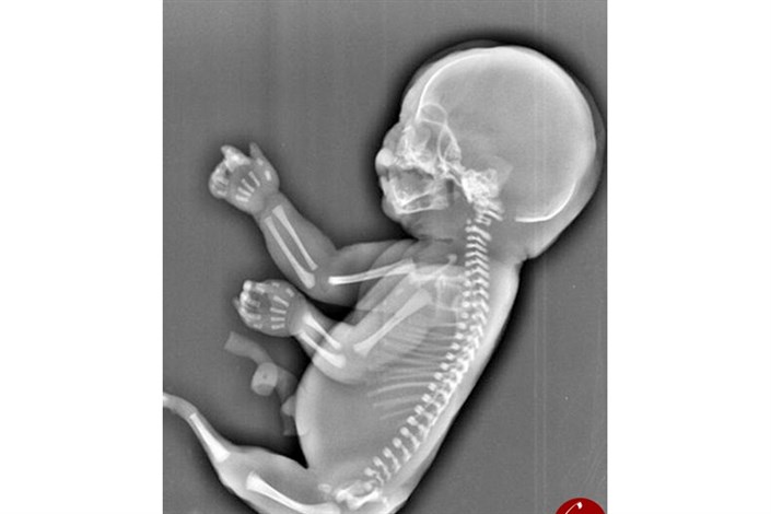 نوزاد پری دریایی قبل از تولد سقط شد/تصاویر