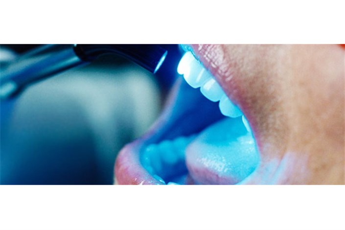 عوارض درمانهای زیبایی دندانپزشکی به روش انجام آنها بستگی دارد
